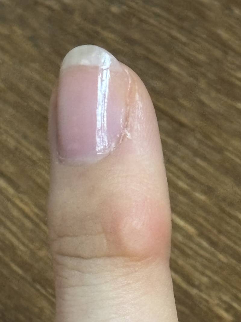 [잡담] 손가락 굳은살 제거 못하나? | 인스티즈