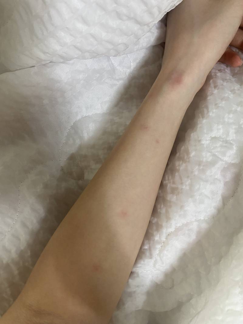 [잡담] 술토하고 팔 이렇게 됐는데 | 인스티즈