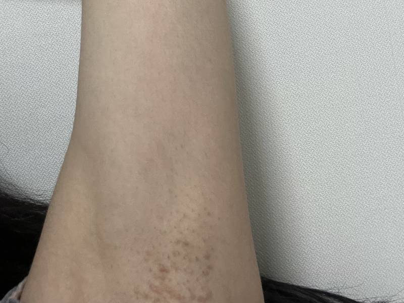 [잡담] 겨드랑이에 피부염 피부과의원으로 가야돼? ㅎㅇㅈㅇ | 인스티즈
