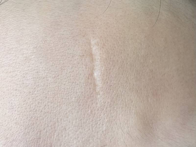 [잡담] 이 꼬맨 흉터 서울가서도 못없애겠지?ㅠㅠ | 인스티즈