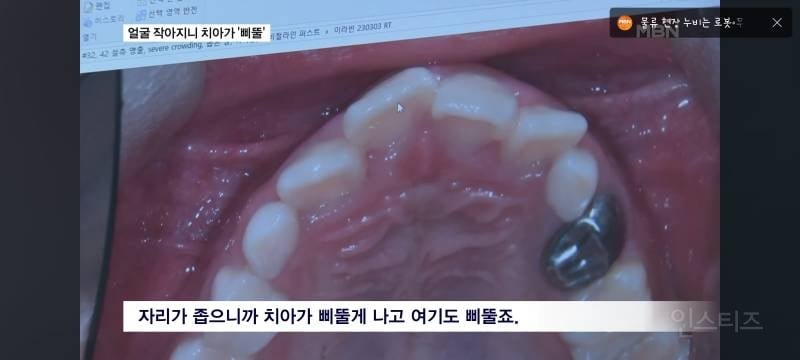 얼굴이 작아져서 치아가 기형으로 나고있다는 요즘 애들.jpg | 인스티즈