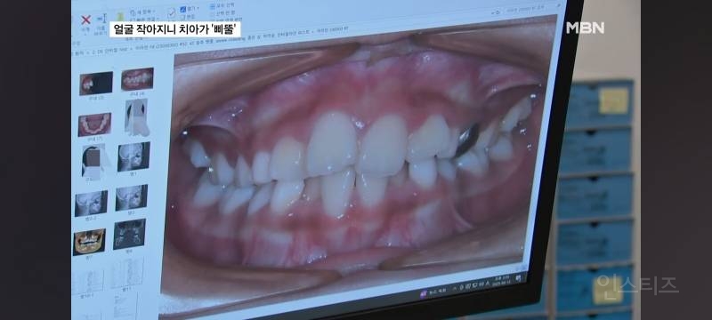 얼굴이 작아져서 치아가 기형으로 나고있다는 요즘 애들.jpg | 인스티즈