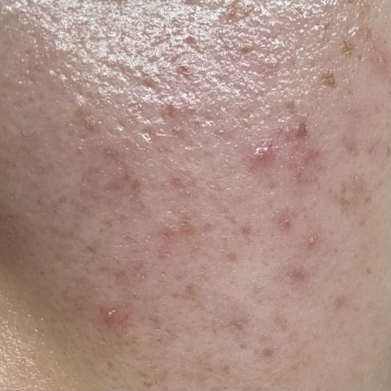 [잡담] 나 피부 매번 첫번째사진 상태였는데 그래도 좀 괜찮아졌지,, | 인스티즈