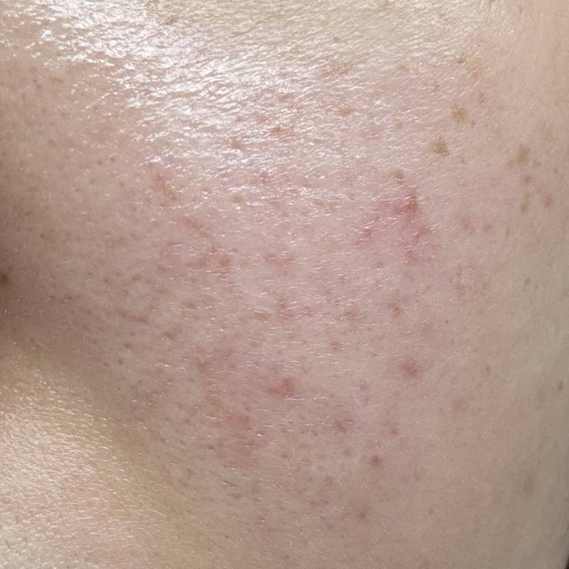 [잡담] 나 피부 매번 첫번째사진 상태였는데 그래도 좀 괜찮아졌지,, | 인스티즈