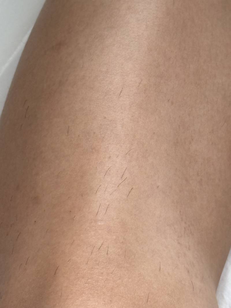 [잡담] 다리 레이저 제모 5회 받았는데 확실히 효과 있는듯? | 인스티즈