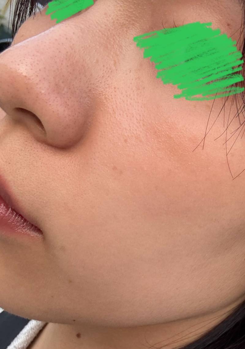 [잡담] 블랙헤드는 도대체 어케 없애냐???????,,,,????? | 인스티즈