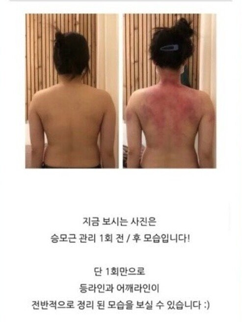 승모근 교정 1회 후기 | 인스티즈