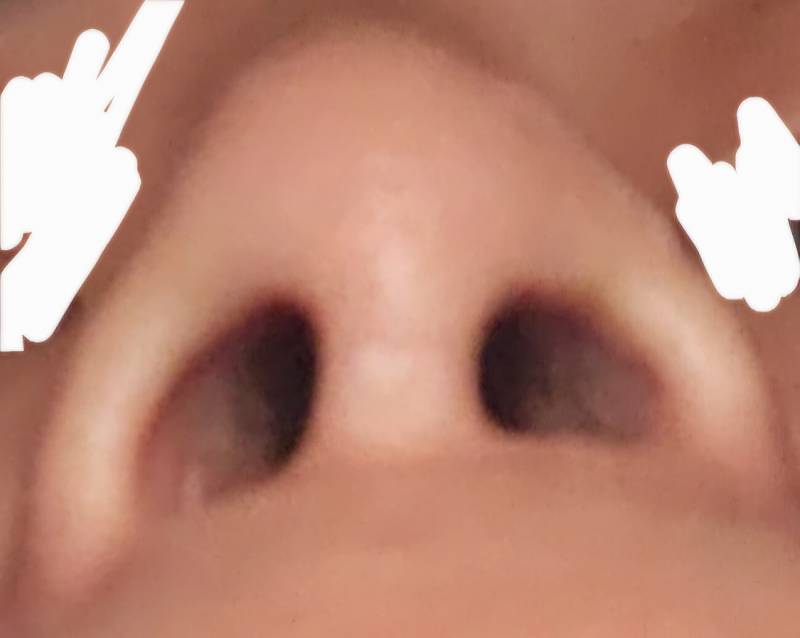 [잡담] ㅎㅇㅈㅇ 코수술했는데 비대칭심해..????? | 인스티즈