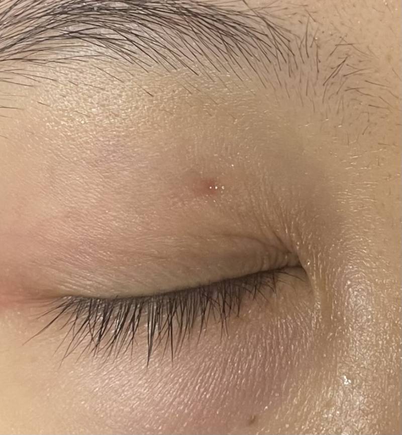 [잡담] 이정도 흉터 얼마만에 나아?ㅠㅠㅠㅠ | 인스티즈