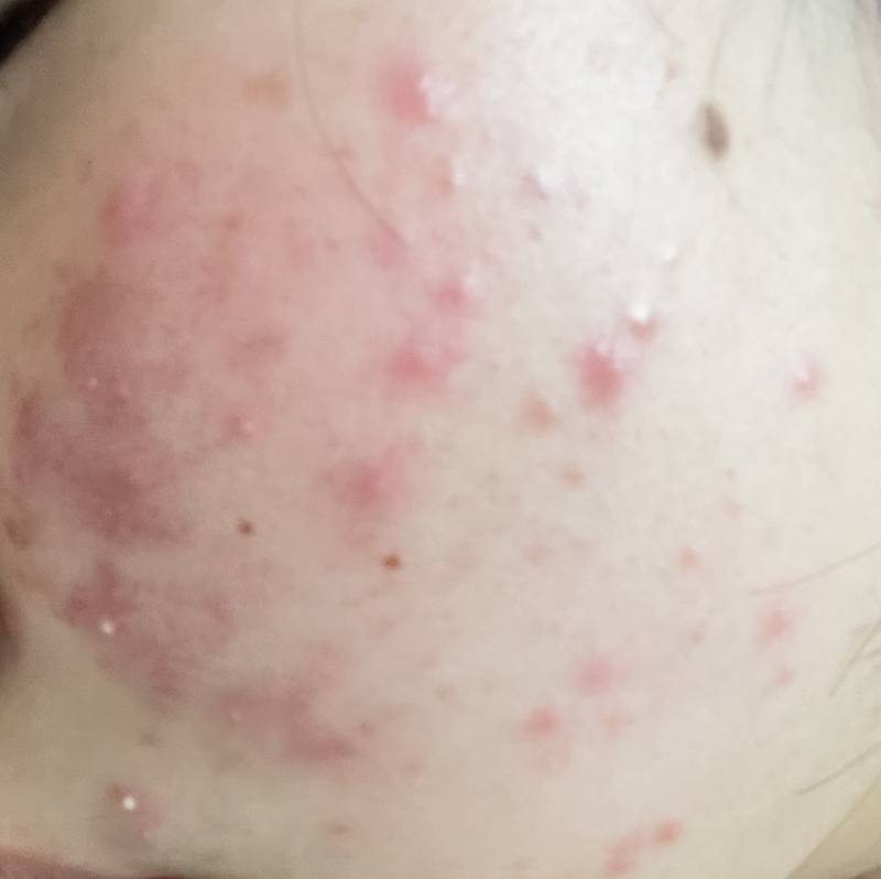 [잡담] 이소타논을 피부과에서 받아서 먹고있는데 이렇게까지 뒤집어지는게 맞아?ㅜㅜ (혐오주의) | 인스티즈