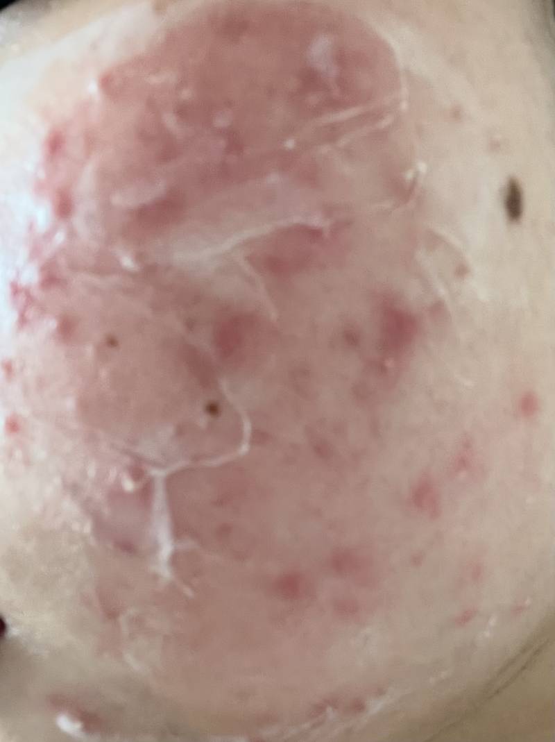 [잡담] 이소타논을 피부과에서 받아서 먹고있는데 이렇게까지 뒤집어지는게 맞아?ㅜㅜ (혐오주의) | 인스티즈