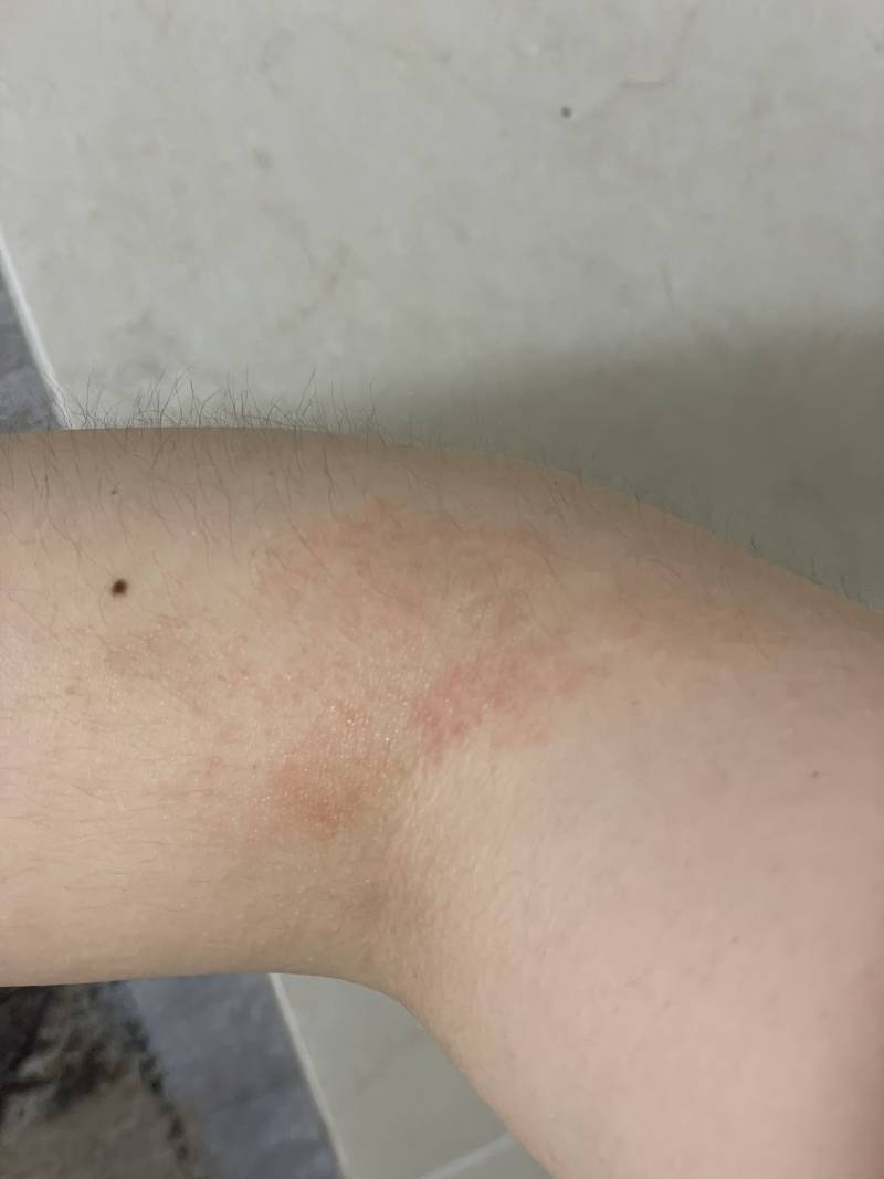[잡담] 얘들아 혹시 나 이거 아토피야..? | 인스티즈