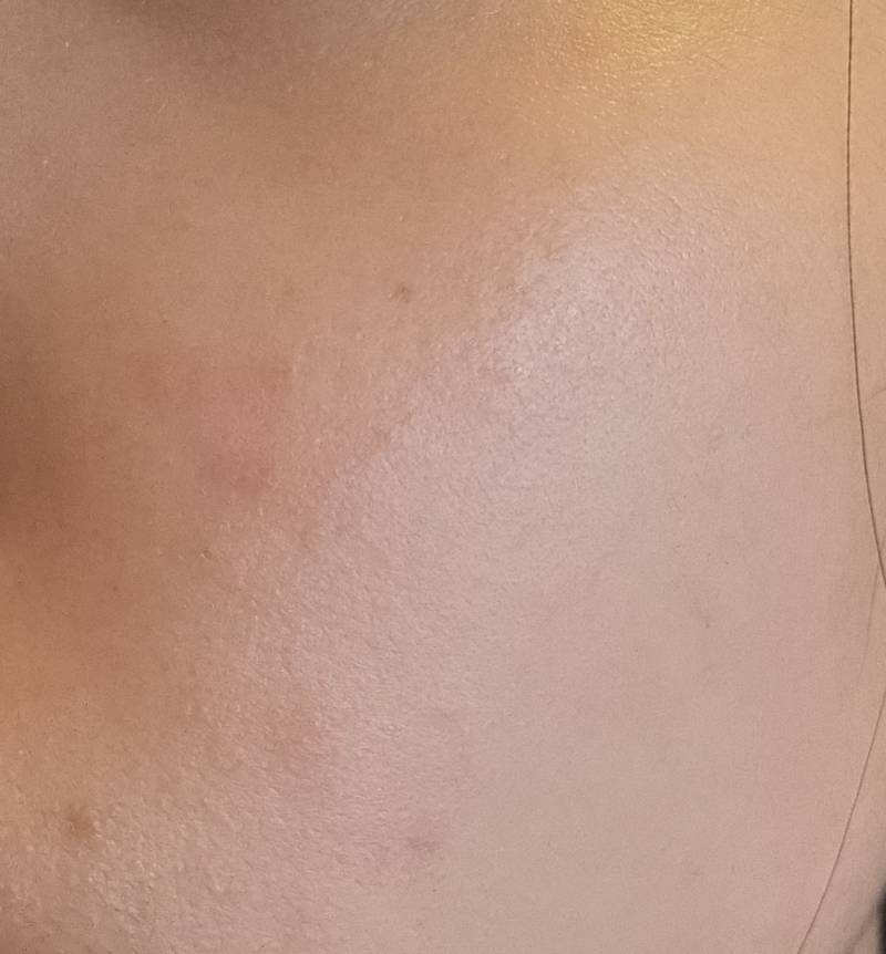 [잡담] 나 피부 뒤집어졌는데 어떻게 해야하지 ㅜㅠ 도와줘 (사진있음) | 인스티즈