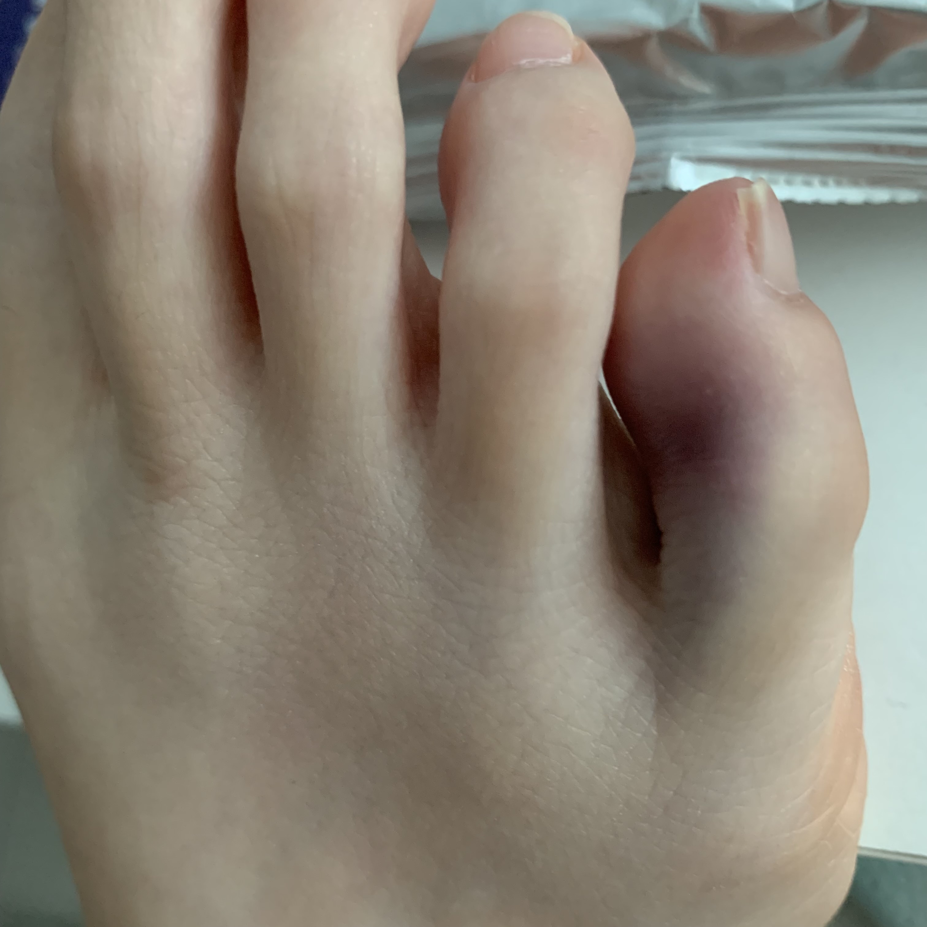 [잡담] 발 다쳤는데 이거 멍 아닌거같은데 뭐야? | 인스티즈