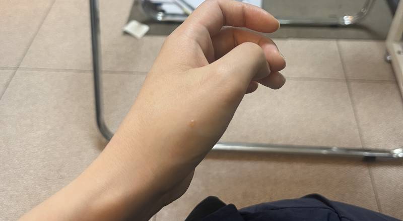 [잡담] 모기물렸는데 왜 물집으로 변했을까..?? | 인스티즈