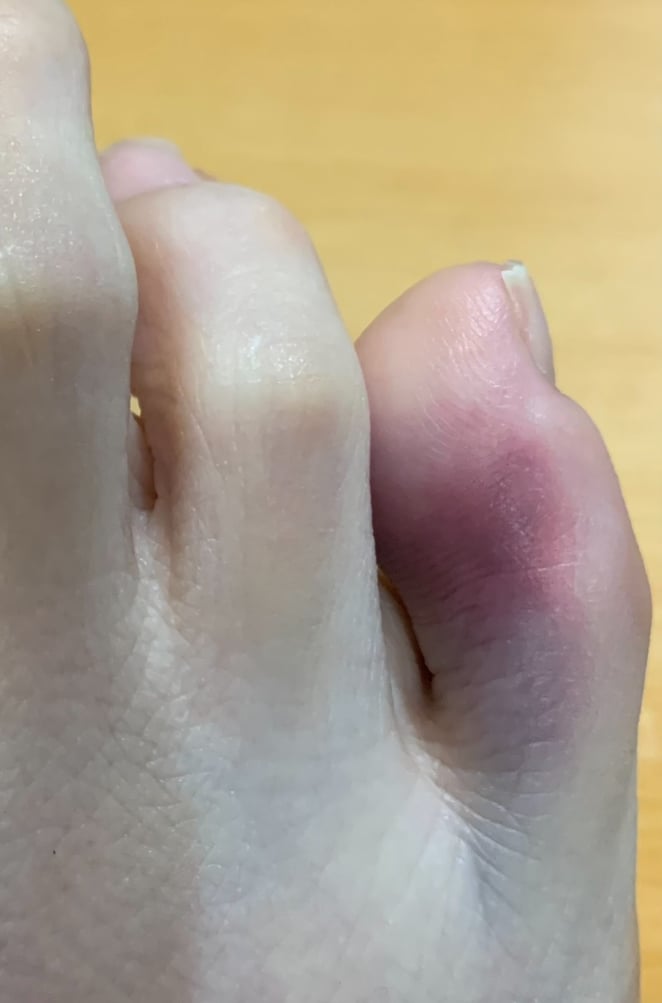 [잡담] 발 다쳤는데 이거 멍 아닌거같은데 뭐야? | 인스티즈