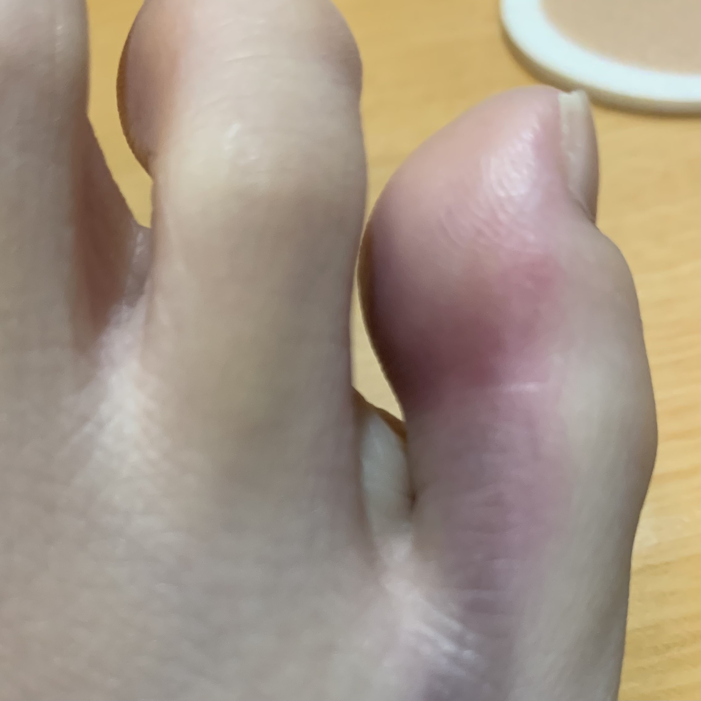 [잡담] 발가락 세게 찧여서 내일 정형외과 갈건데 반깁스 꼭 해야돼? | 인스티즈