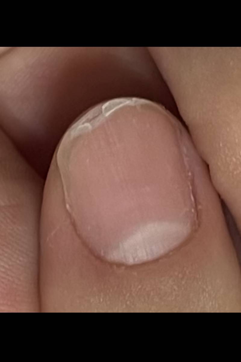[잡담] 손톱 껍질 벗겨지는 거 해결하는 방법이 뭘까?ㅠㅠ | 인스티즈