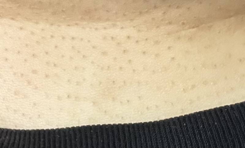 [잡담] 목에 피부 이런건 어찌해야돼? 약ㅎㅇㅈㅇ | 인스티즈