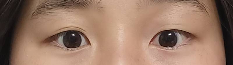 [잡담] 쌍수 성공할 수 있는 눈일까 | 인스티즈