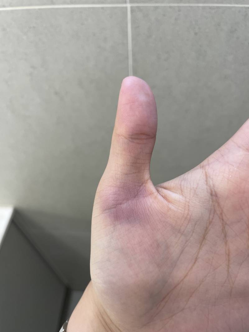 [잡담] 뭘 했길래 여기에 멍이 들까???? | 인스티즈