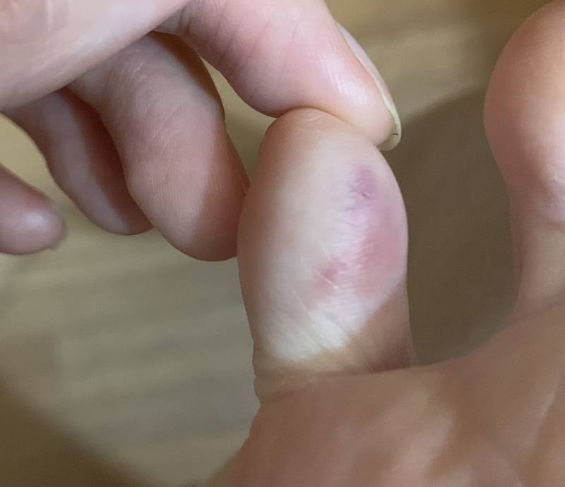 [잡담] 발 다쳤는데 이거 멍 아닌거같은데 뭐야? | 인스티즈