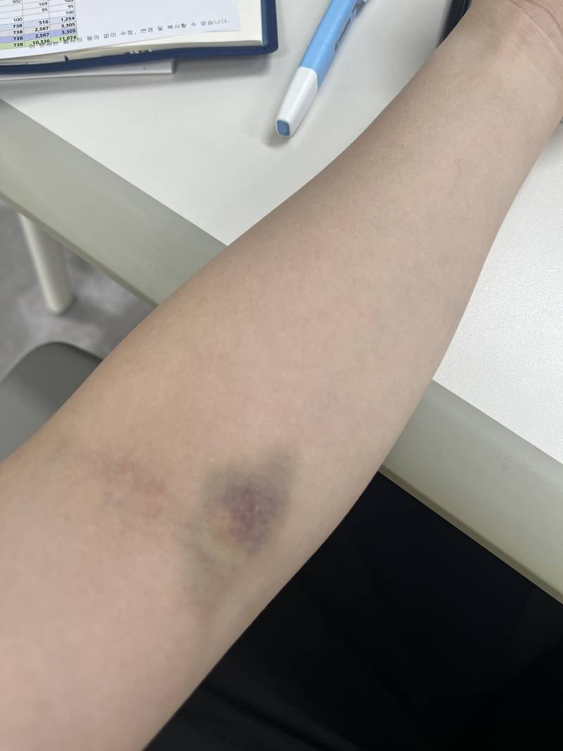 [잡담] 나 호르몬 수치 검사 때문에 피 뽑고 멍 들었는데 | 인스티즈