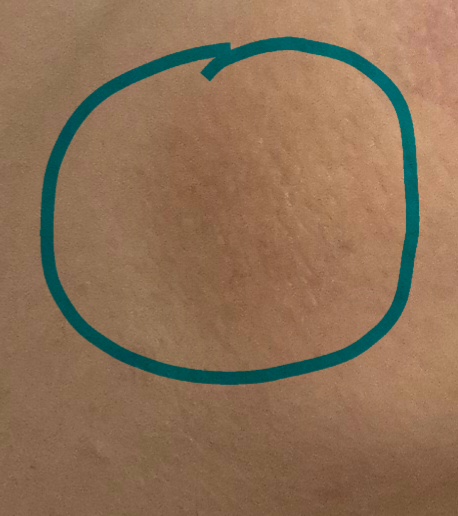 [잡담] 이거 데인 자국일까? 기억이 없는데 피부 일부가 까맣고 거칠어 | 인스티즈
