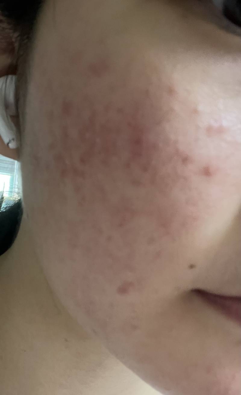 [잡담] (혐주의ㅜㅠ)어떡해? 화장으로 피부뒤집어졌어ㅠㅜ… | 인스티즈