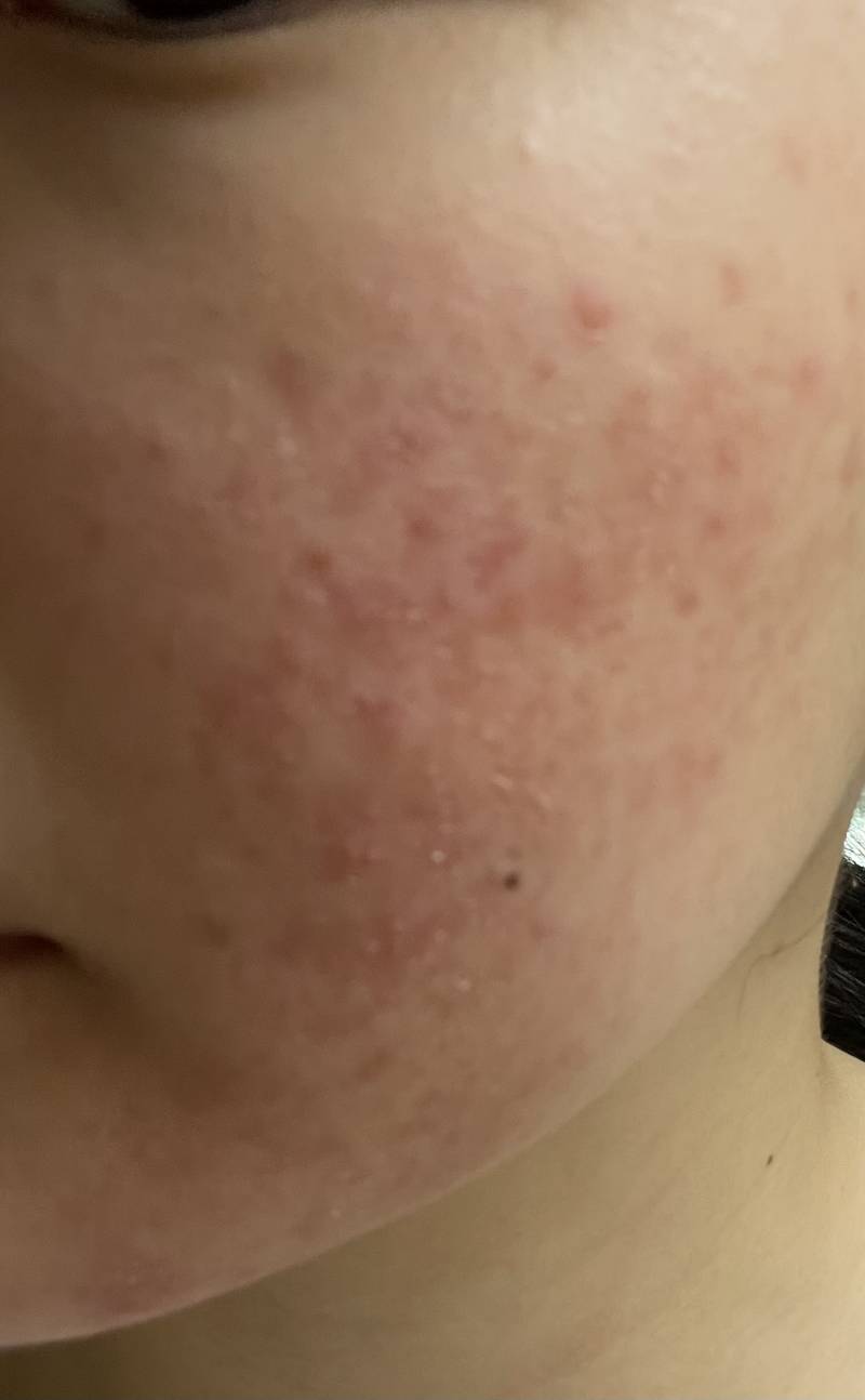 [잡담] (혐주의ㅜㅠ)어떡해? 화장으로 피부뒤집어졌어ㅠㅜ… | 인스티즈