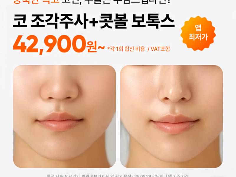 [잡담] 코조각주사 콧볼보톡스 맞아본사람 있어? 효과 진짜 이래?? | 인스티즈