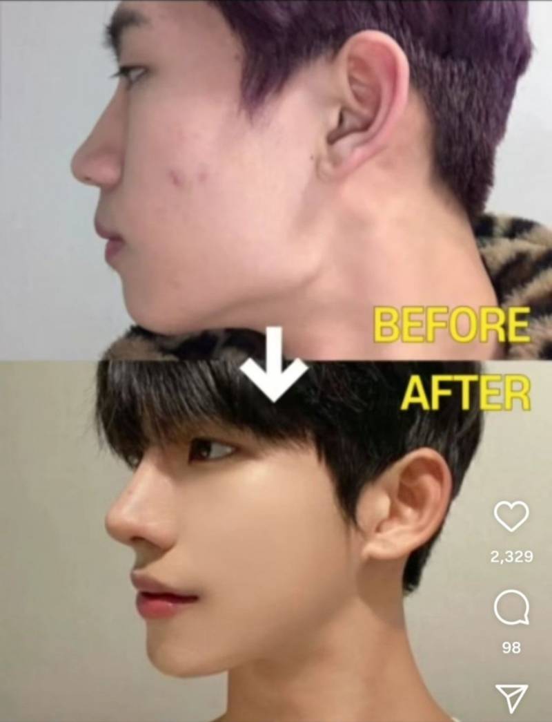 현재 취향 갈린다는 성형 비포 애프터 사진.JPG | 인스티즈