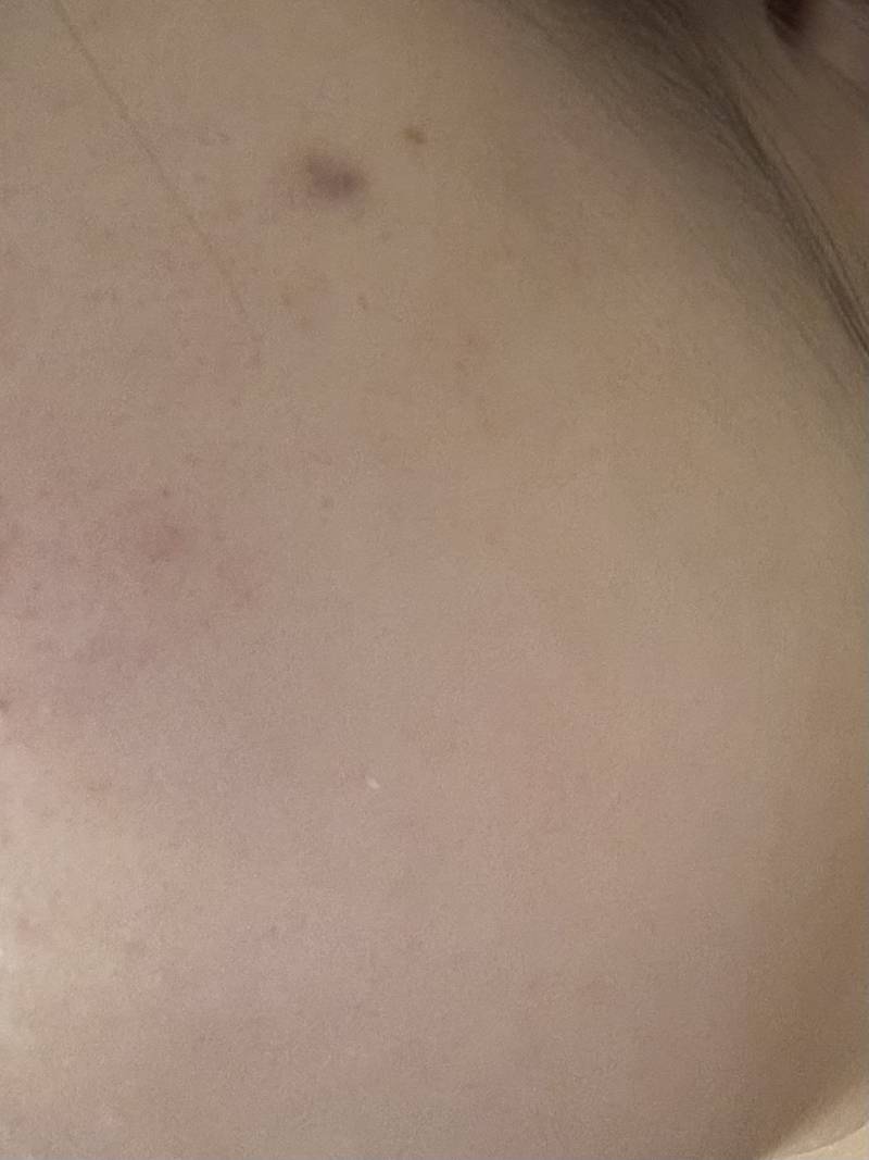 [잡담] 점이 갑자기 생길 수도 있어? | 인스티즈