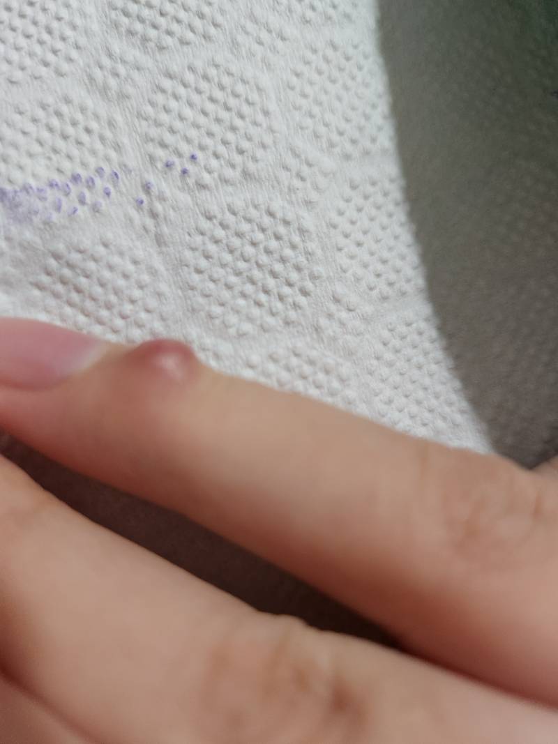 [잡담] 손가락 결절종 걸려본 익 있어?? 사진주의 | 인스티즈