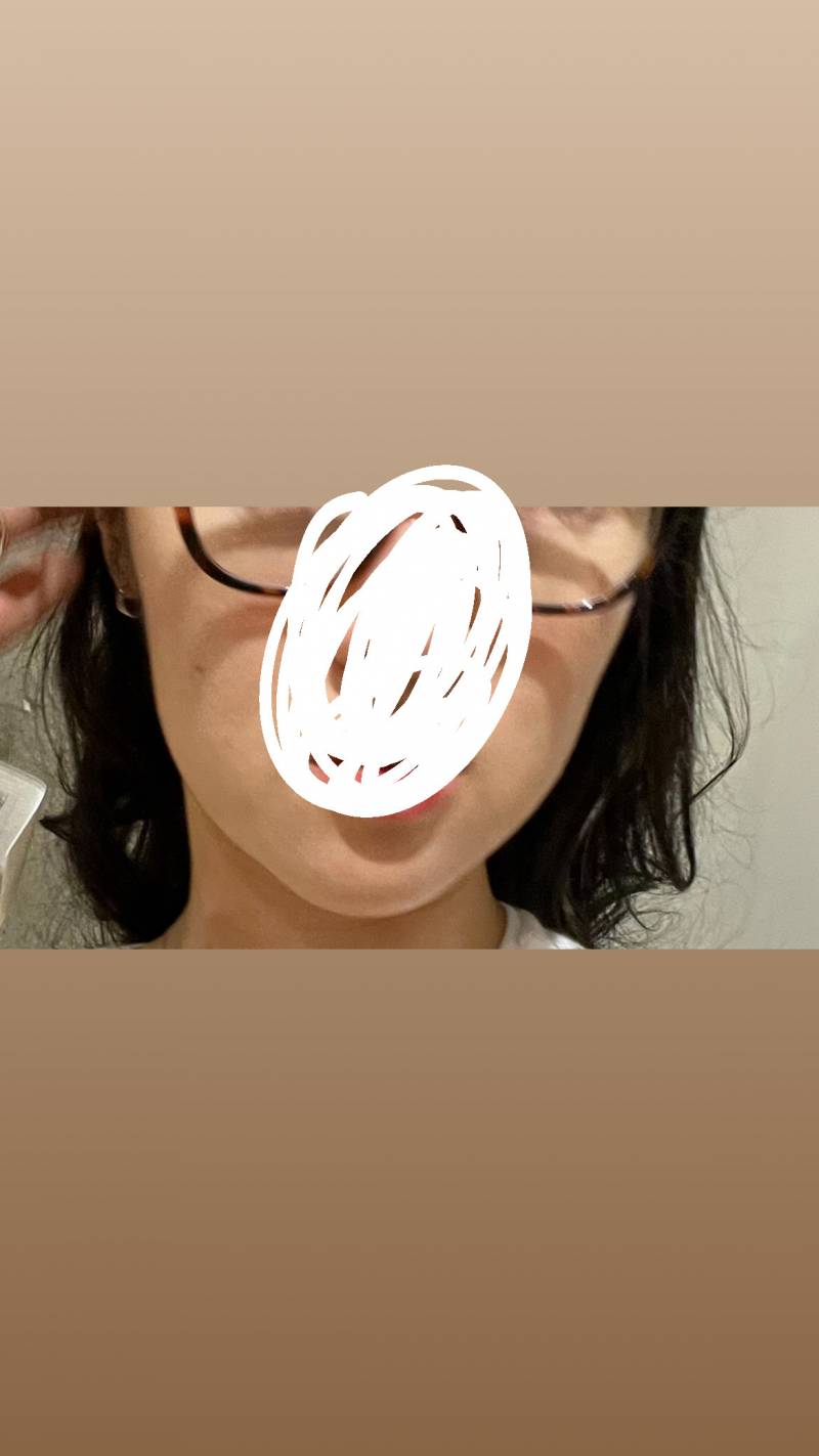 [잡담] 아니 이런 턱볼살? 빼려면 어케해야해?? | 인스티즈