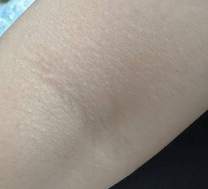 [잡담] 온몸 곳곳에 이런 오독토돌 뭐가 났는데 왜이러지 | 인스티즈