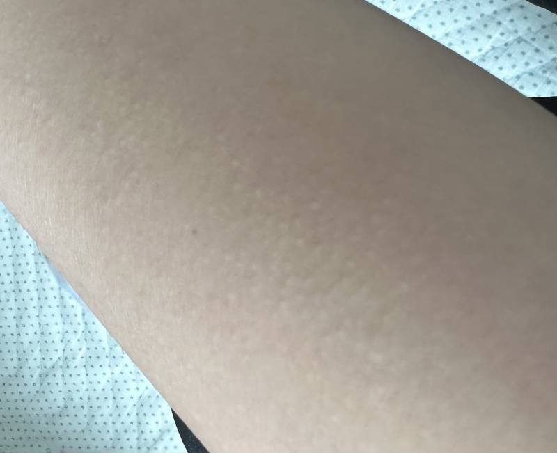 [잡담] 온몸 곳곳에 이런 오독토돌 뭐가 났는데 왜이러지 | 인스티즈