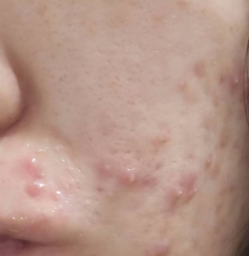 [잡담] 나 피부 많이 좋아졌다🥺😭 | 인스티즈