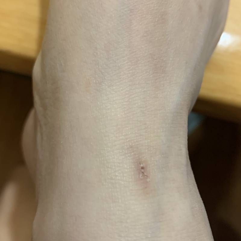 [잡담] 상처난지 일주일 됐는데 익들이라면 마데카솔 계속 바를거야? | 인스티즈