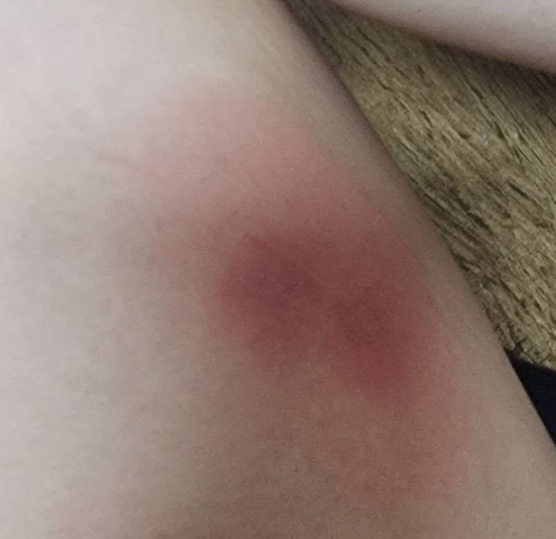[잡담] 얘들아 이거 모기 물린거 맞아? | 인스티즈