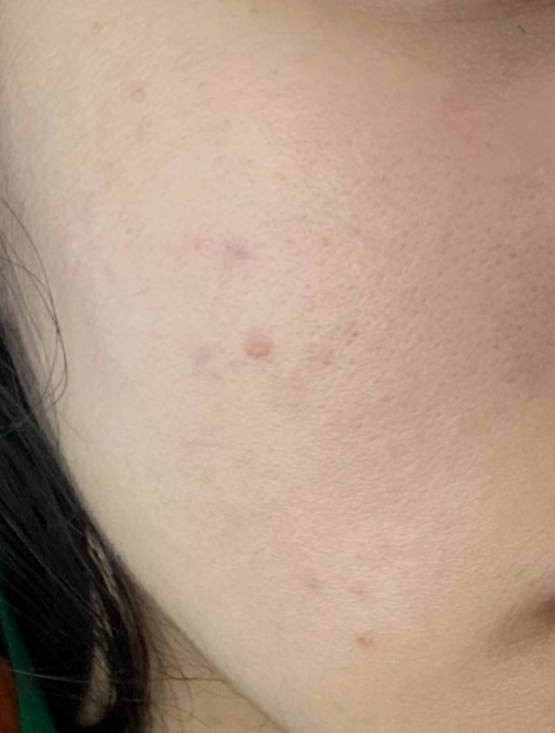 지금 피부 이런데 리들샷 써도 되겠지?? | 인스티즈