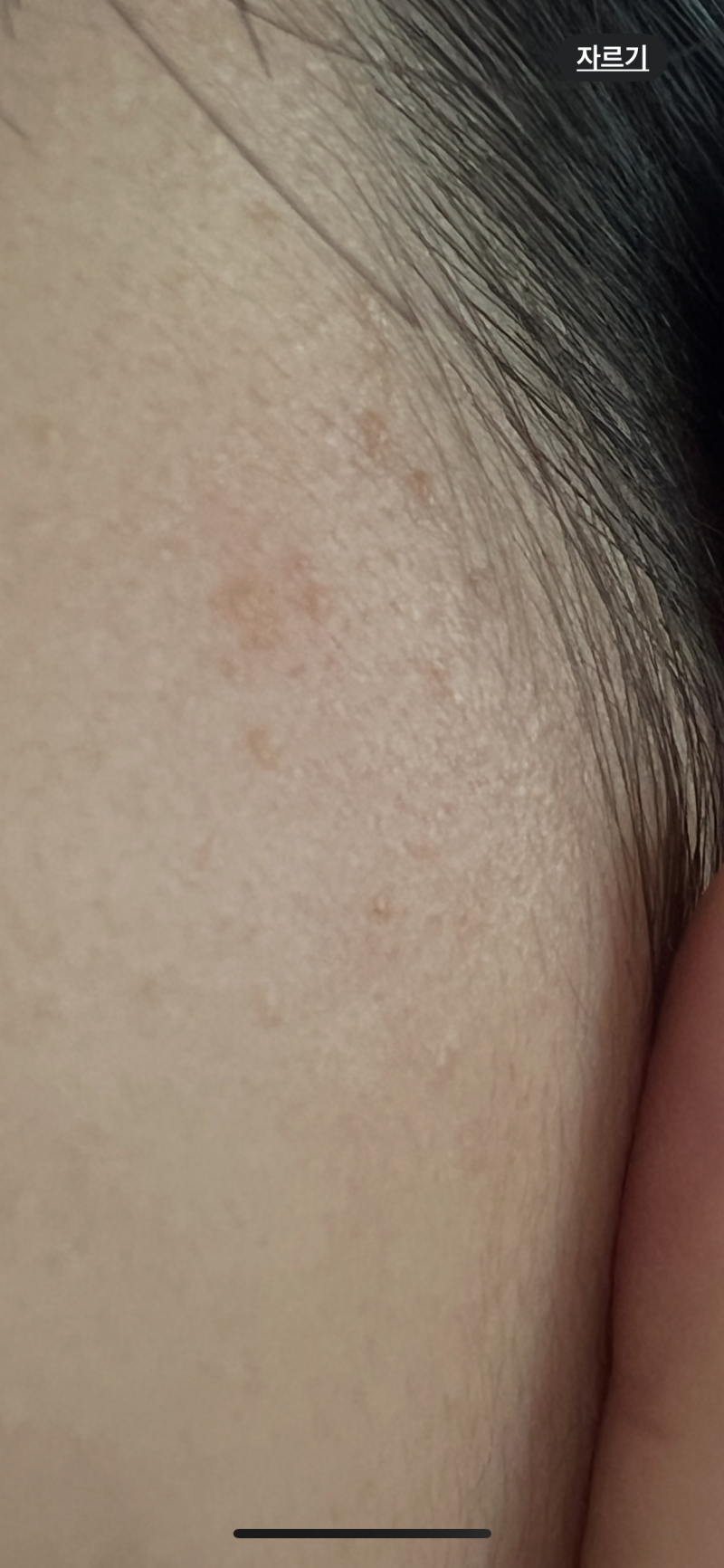 [잡담] 편평사마귀 이거 꼭 없애야되나?ㅠㅠ | 인스티즈
