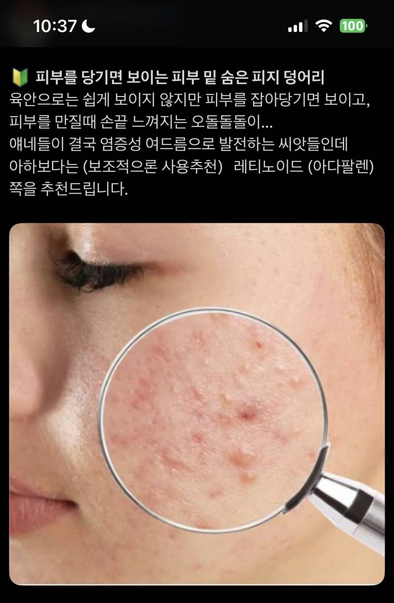 [잡담] 피부과 압출 잘 아는익 있오??? | 인스티즈