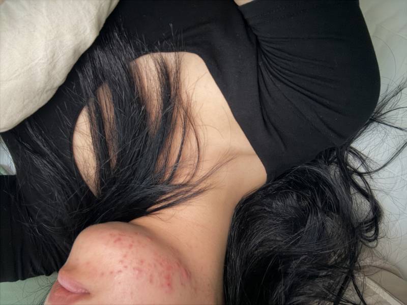 [잡담] 턱에만 여드름 나는 거면 산부인과 가봐야겠지? ㅠㅠ | 인스티즈