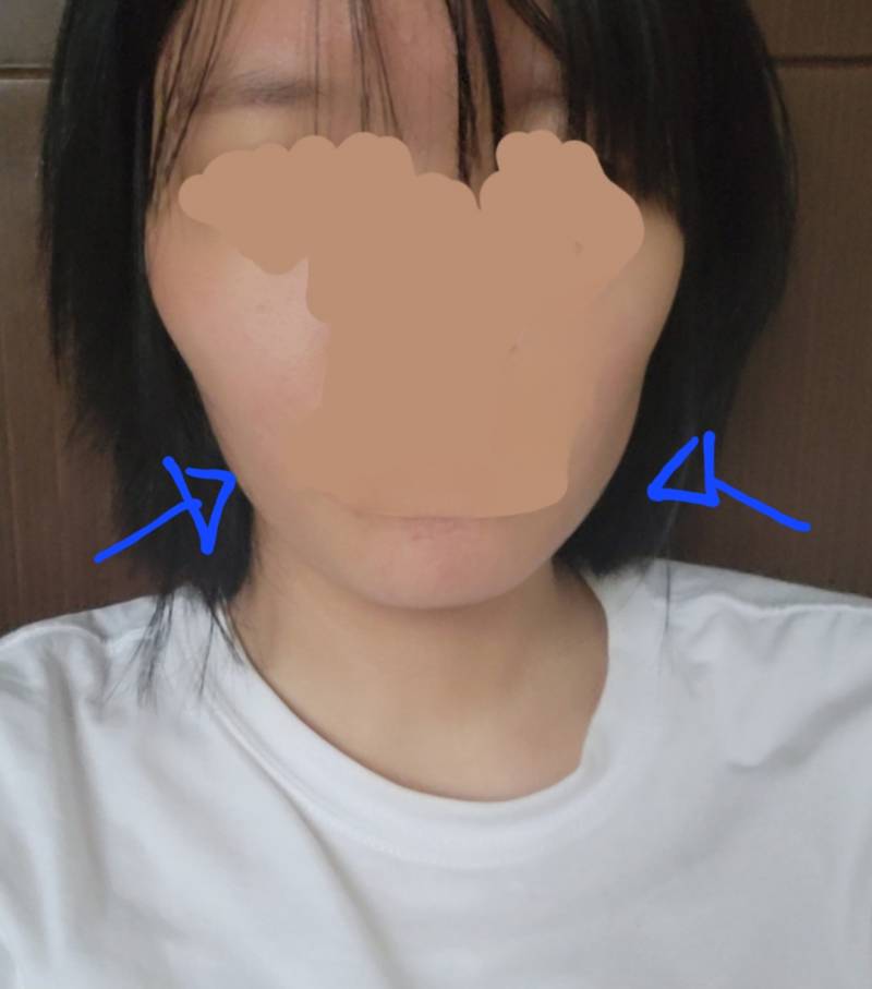 [잡담] 땅콩형도 천천히 살 빼도 옆이 많이 꺼짐?? | 인스티즈