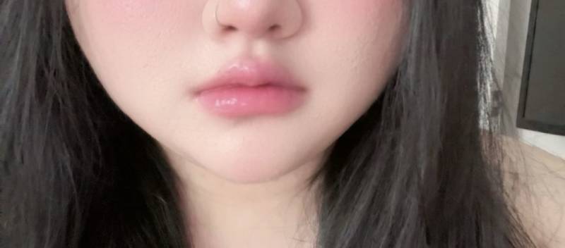 [잡담] 얼굴 지방흡입 두달넘음 | 인스티즈