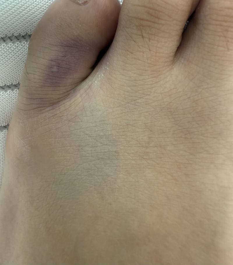 [잡담] 어제 문에 새끼발가락 쎄게 부딛히고 오늘 아침되서 봤는데 | 인스티즈