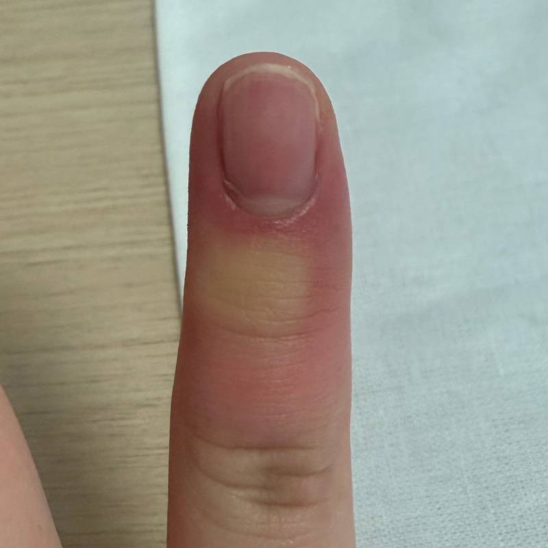 [잡담] 잉 머지 무슨 벌레에 물렸나봄 ,, 개땡땡부었어 갑자기 | 인스티즈