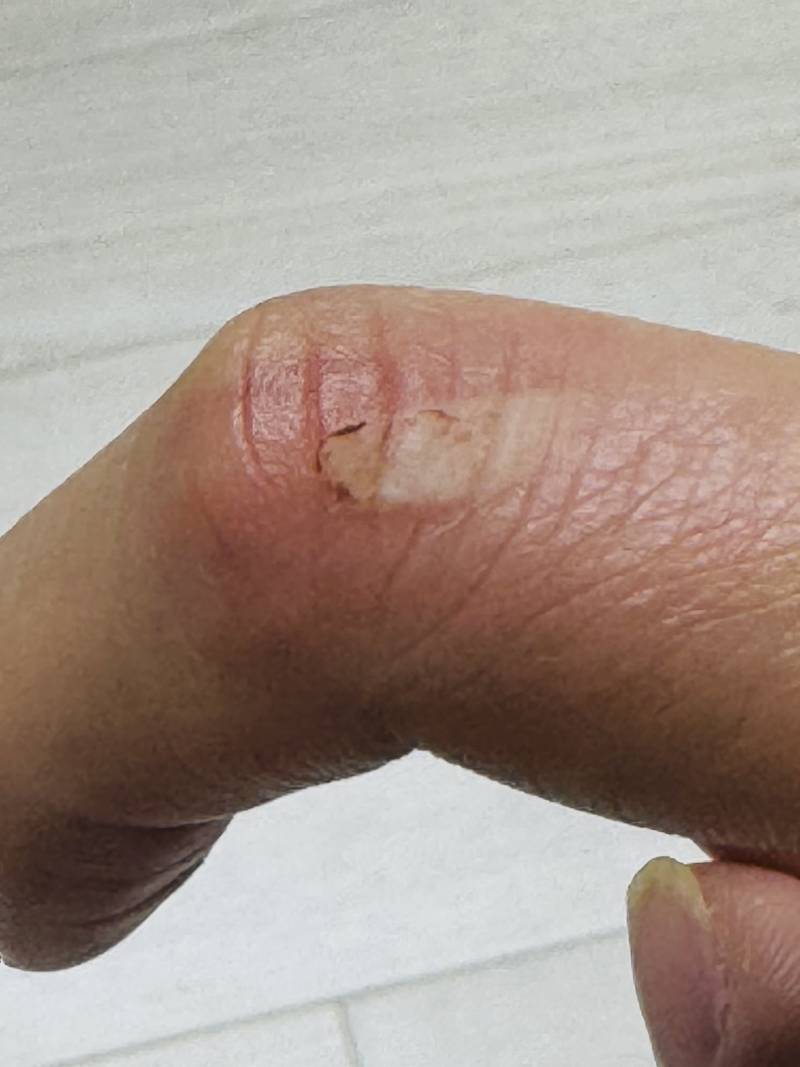 [잡담] 화상 입었는데 병원 가야될까? | 인스티즈