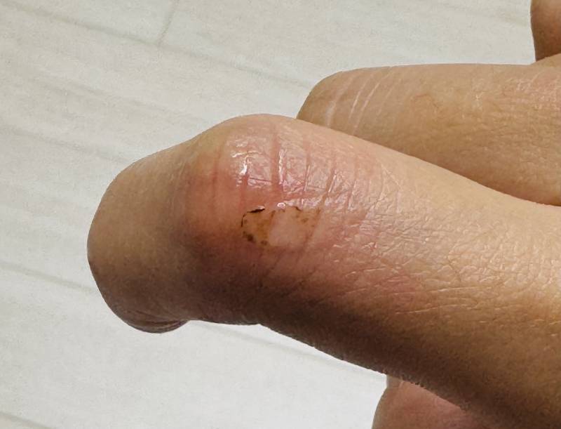 [잡담] 화상 입었는데 병원 가야될까? | 인스티즈